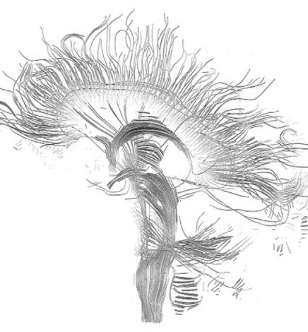 Tractografía por tensor de difusión